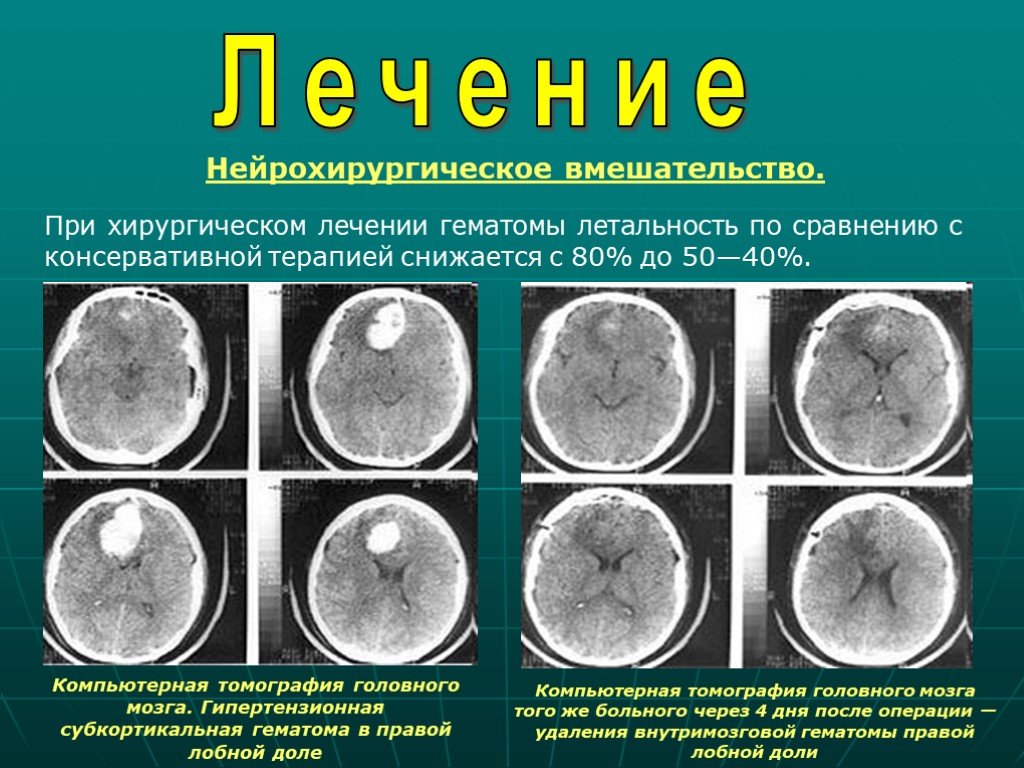 Последствия после гематомы головного мозга. Гипертензионная субкортикальная гематома в правой лобной доле. Подострая эпидуральная гематома. Хирургическое лечение эпидуральной гематомы.