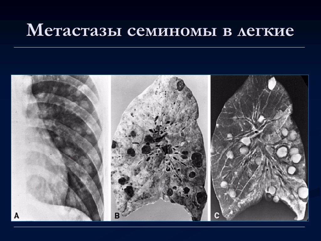 Метастазы при раке легких. Метастазы семиномы в легкие. Метастазирование в легкие.