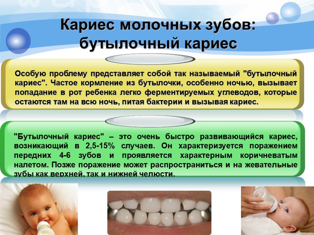 Лечение молочных. Молочные зубы - бутылочный кариес. Бутылочный кариес у детей. Бутылочный Кариас у ребёнка. Бутылочный кариес на зубах.