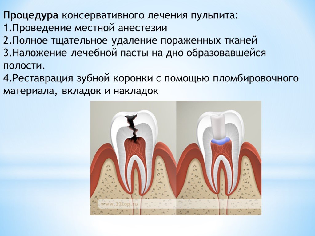 Образовавшихся полостей