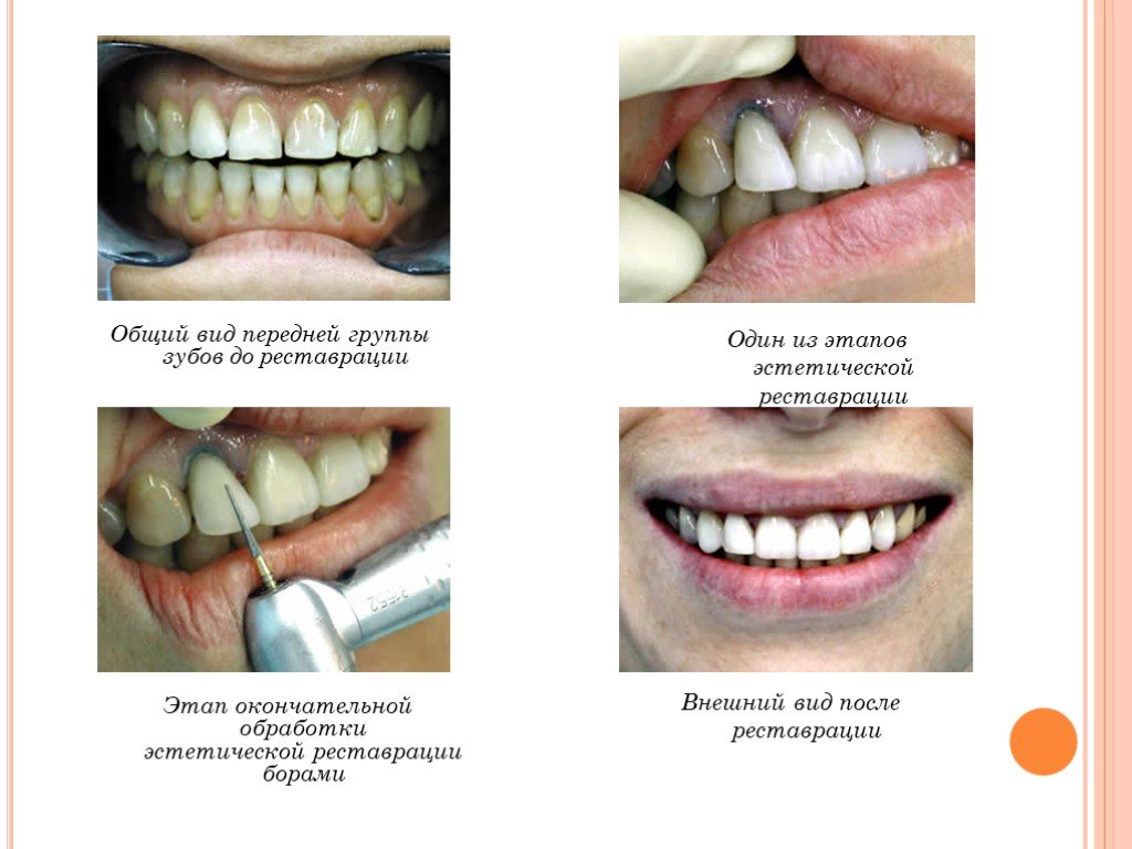 Фронтальные зубы это какие зубы фото