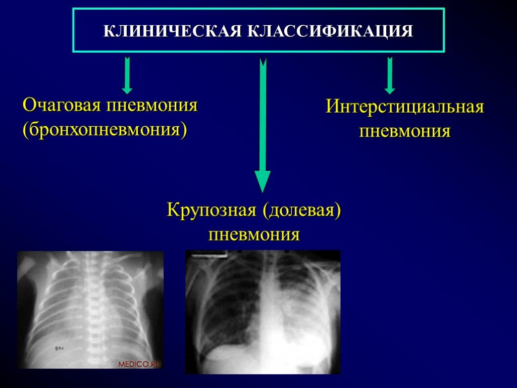 Бронхопневмония у детей. Осложнения очаговой пневмонии. Крупозная и очаговая пневмония. Крупозная пневмония и очаговая пневмония. Крупозная долевая пневмония.