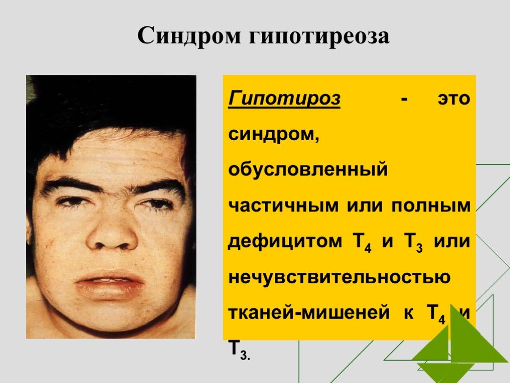 Гипотиреоз у девочек. Проявления гипотиреоза внешние. Гипотиреоз симптомы у подростка. Гипотиреоидный синдром.