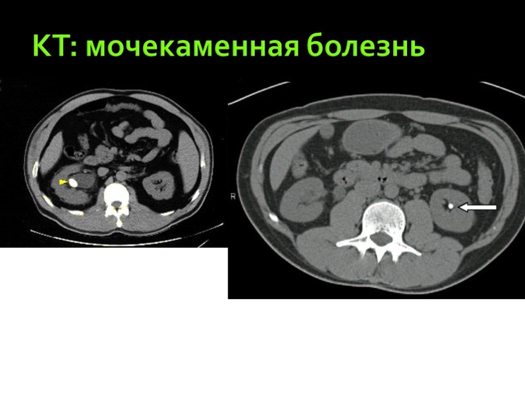 Запись на кт. Мочекаменная болезнь кт. Компьютерная томография при мочекаменной болезни. Кт почек мочекаменная болезнь. Кт почек при мочекаменной болезни.