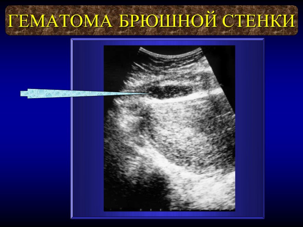 Послеоперационная полость. Предбрюшинная гематома. Гематома брюшной полости на УЗИ. Гематома передней брюшной стенки на УЗИ. Гематома передней боюшнрй снеки УЗИ.