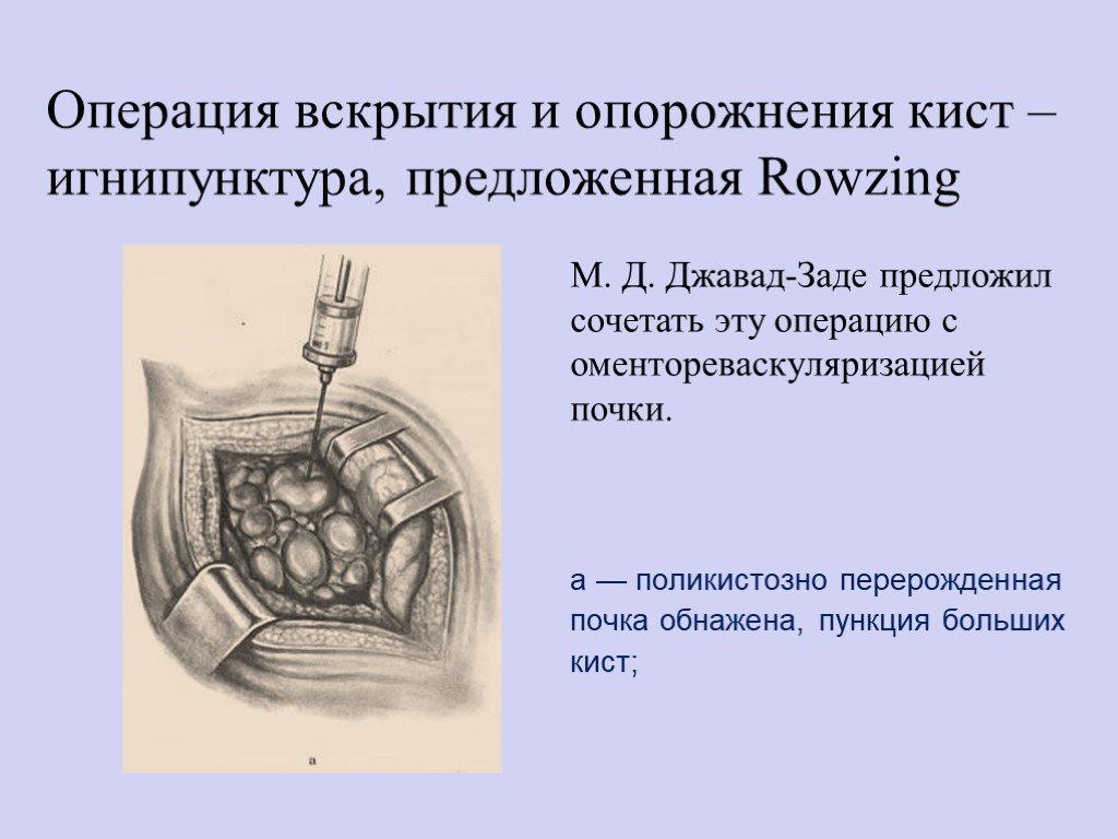 Киста почки лечение операция