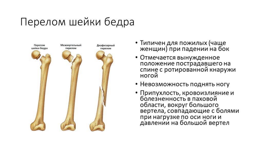 Перелом шейки бедра презентация