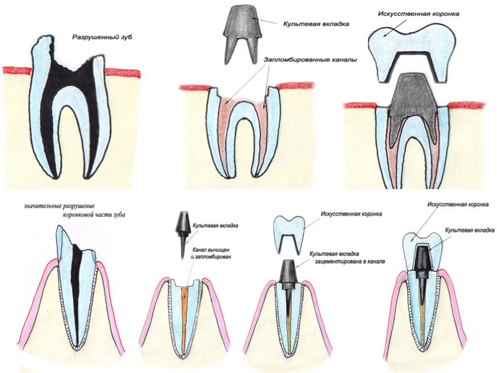 Коронка на зуб картинки