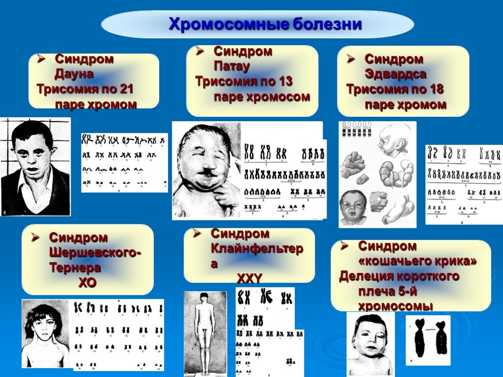 Хромосомные. Хромосомные болезни. Хромосомные болезни синдром Патау. Синдром Эдвардса и Патау.