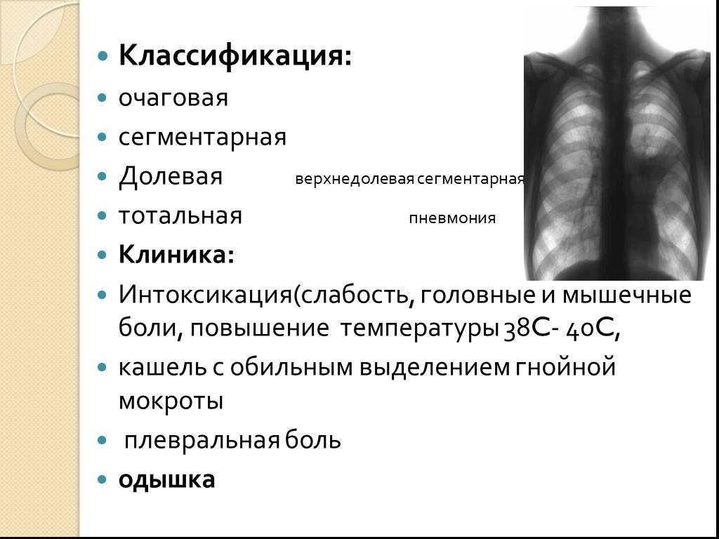 Сегментарная пневмония