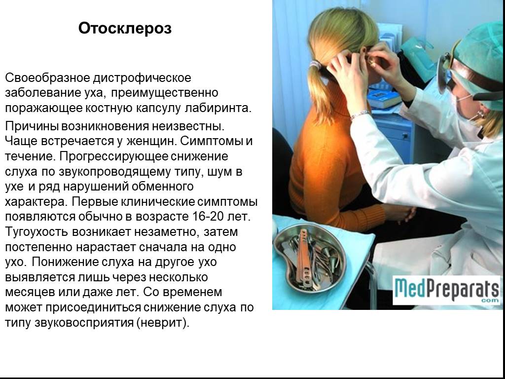 Отосклероз по утвержденным клиническим рекомендациям. Заболевания органов слуха. Отосклероз причины.