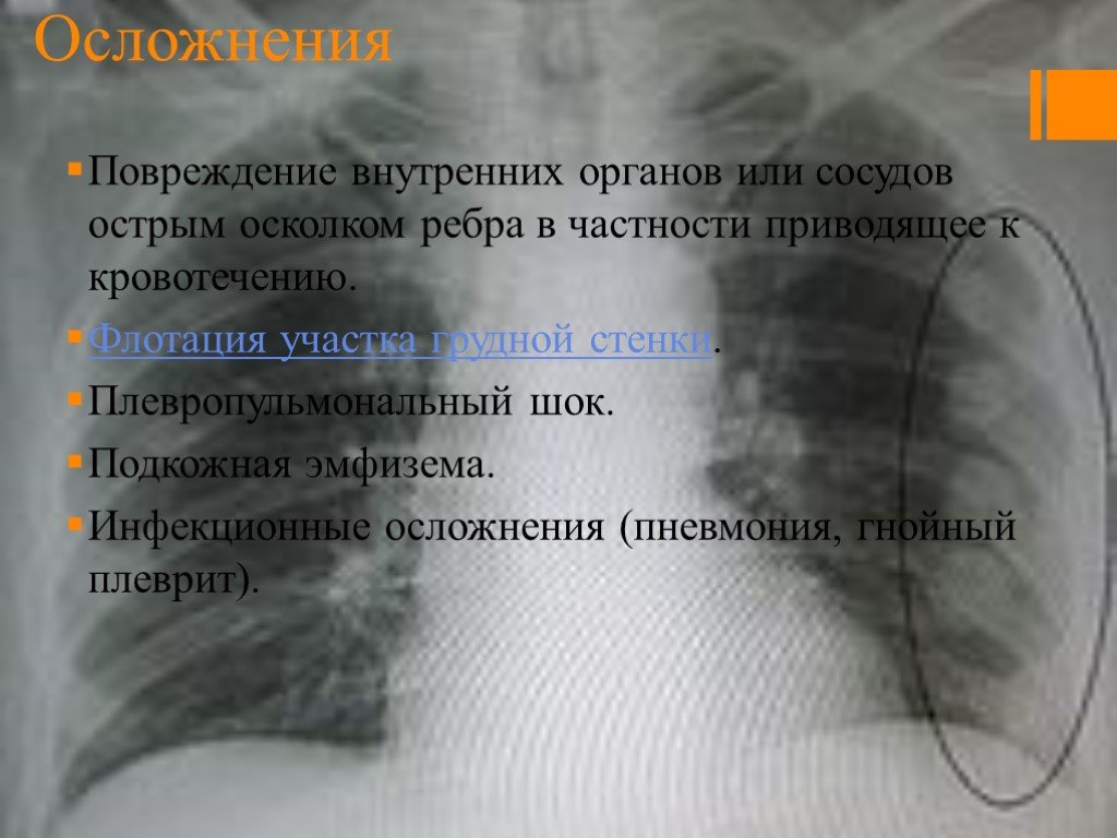 Внутренние травмы тест. Травмы внутренних органов разрывы. Ушиб внутренних органов. Перелом ребер с эмфиземой. Закрытая травма с повреждением внутренних органов.