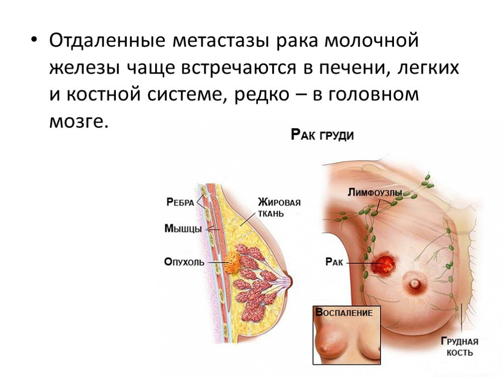 Метастаз молочных желез. Опухоль молочной железы. Метастазы в молочной железе. Новообразование в грудной железе. Метастазы м молочной железы.