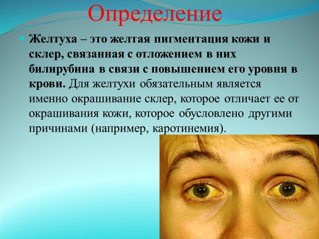 Почему после желтого. Внешние симптомы желтухи. Желтуха у взрослых причины симптомы. Желтуха у взрослых причины возникновения.