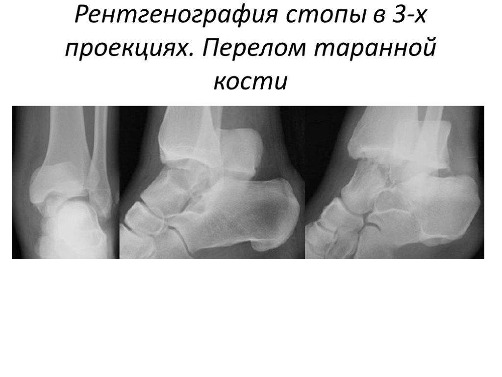 Рентген в 2 проекциях. Таранная кость перелом рентген. Таранная кость стопы перелом. Перелом таранной кости рентген. Перелом пяточной кости и таранной кости.