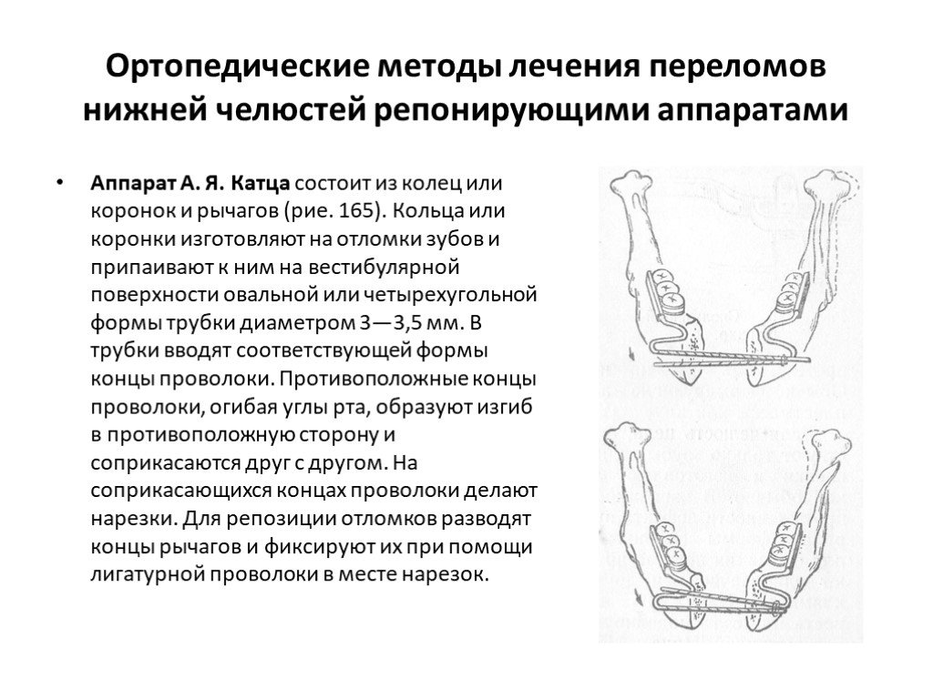 Перелом нижний. Ортопедические методы переломов нижней челюсти. Ортопедические методы лечения переломов челюстей. Аппараты для репозиции отломков челюстей. Ортопедические методы лечения переломов нижней челюсти.