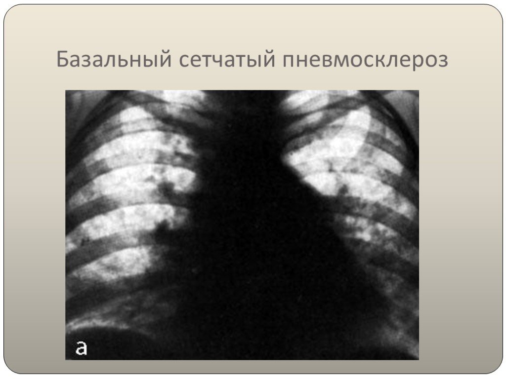 Локальный пневмофиброз легких