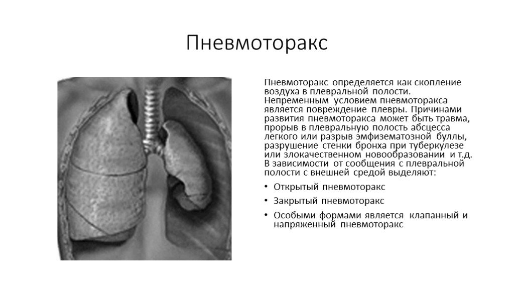 Симптомы пневмоторакса у взрослых