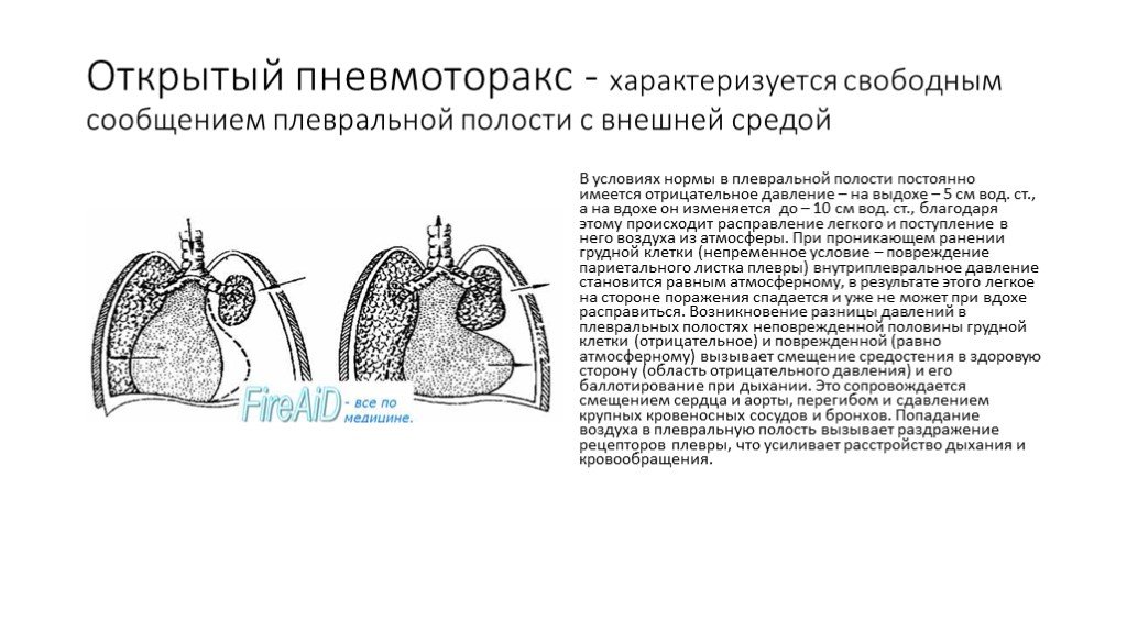 Открытый пневмоторакс. Давление в плевральной полости. Пневмоторакс.. Давление в плевральной полости при открытом пневмотораксе. Изменение давления в плевральной полости при пневмотораксе. Давление в плевральной полости при пневмотораксе.