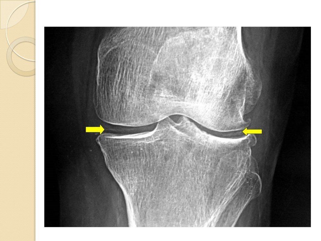 Артроз коленного сустава мениск. Пирофосфатная артропатия рентген коленного сустава. Хондрокальциноз коленного сустава рентген. Обызвествление хряща коленного сустава рентген. Хондрокальциноз и пирофосфатная артропатия.