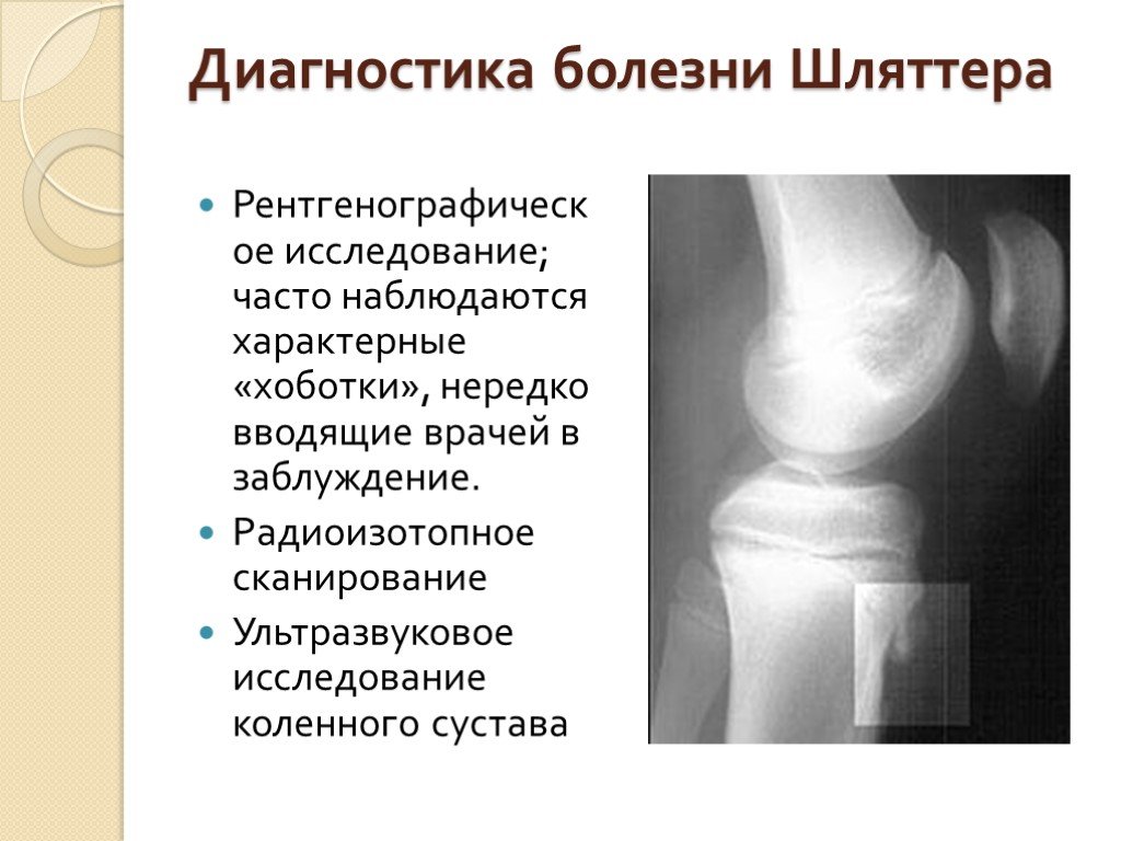 Асептический некроз коленного сустава лечение. Болезнь Осгуд Шляттера осложнения. Болезнь Осгуд Шляттера рентген. Болезнь Осгуда-Шлаттера рентген. Рентген коленного сустава болезнь Осгуда Шлаттера.