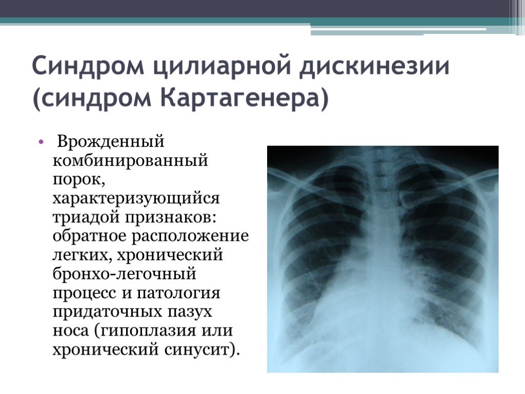 Пороки развития легких презентация