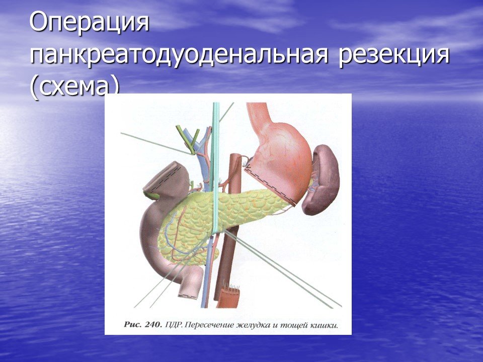 Резекция печени