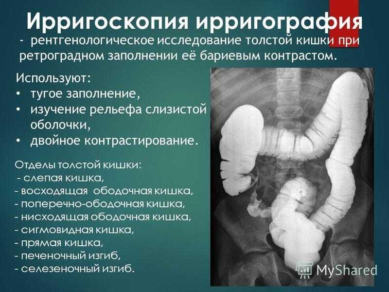 Ирригоскопия кишечника что это. Рентгенологическое исследование Толстого кишечника (ирригоскопия).. Методики рентгенологического исследования толстой кишки. Ирригоскопия используемое контрастное вещество. Исследование толстой кишки ирригоскопия.