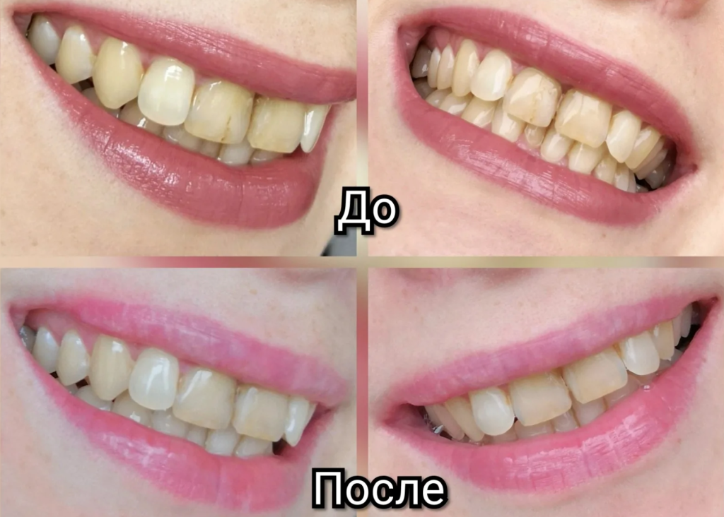 Зубы после 30. Зубы до и после АИР флоу. Профессиональная чистка зубов до и после. Зубы после проф чистки зубов.