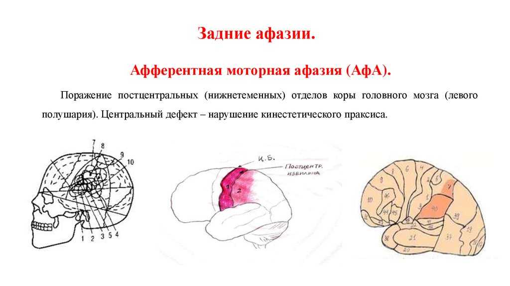 Афазии локализации поражения. Зоны поражения мозга при афазии. Очаг поражения при афферентной моторной афазии. Афазия головного мозга моторная. Афферентная моторная афазия локализация очага поражения.