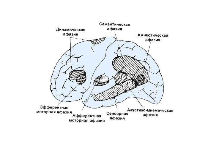 Афазии локализации поражения. Афазии схема мозга. Афазия сенсорная моторная динамическая. Формы афазии по Лурия. Схема локализации разных форм афазия.