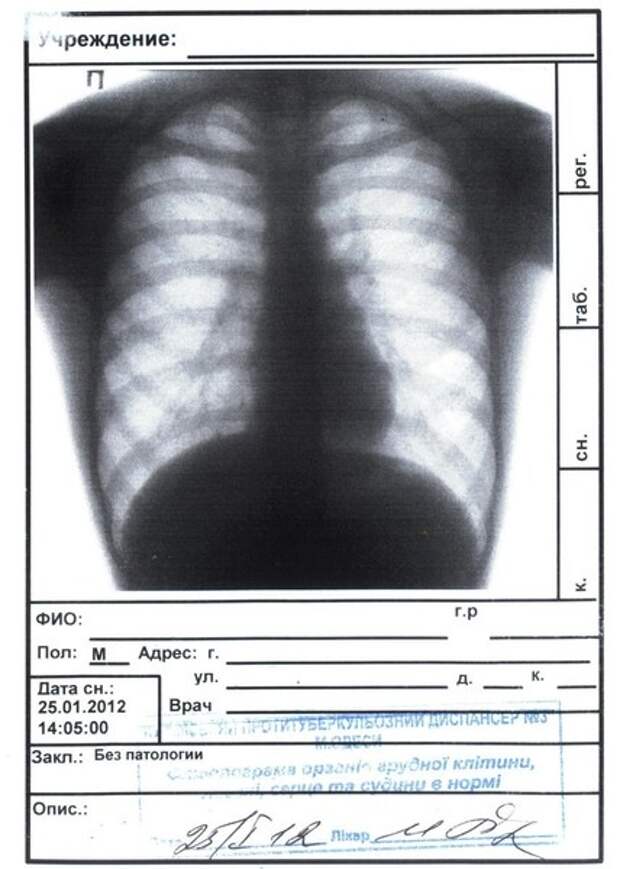 Без видимых патологий. Флюорография легких здорового человека заключение без патологии. Флюорография органов грудной клетки норма. Флюорография легких в 3 проекциях. Флюорография легких цифровая 2 проекции.