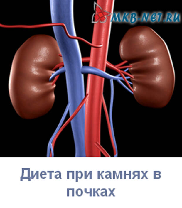 Микролиты в почках. Камни в почках противопоказания. Стенд для почки при камнях. Исход при камнях в почках.