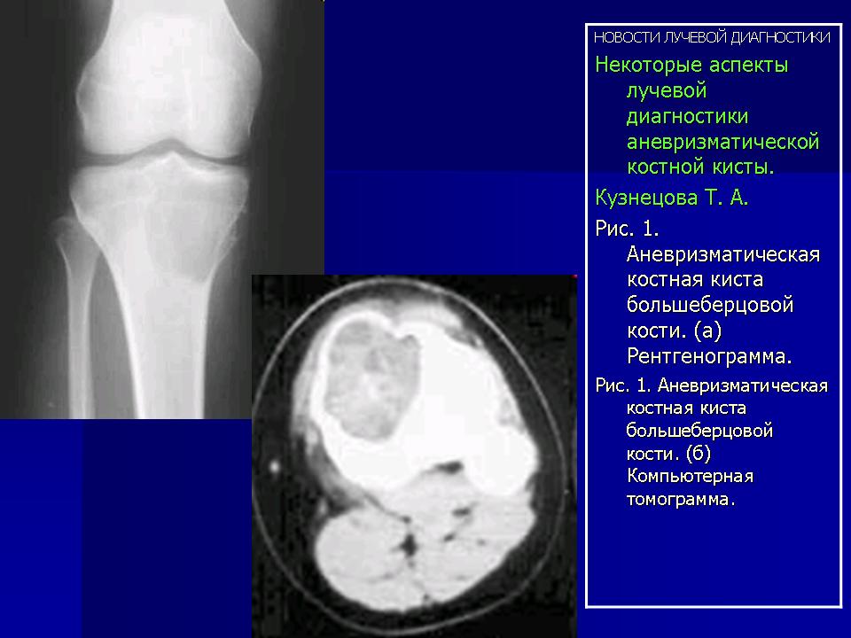 Операция кисты кости. Аневризматическая костная киста бедренной кости кт. Аневризматическая костная киста большеберцовой кости мрт. Аневризматическая костная киста большеберцовой кости рентген. Аневризмальная киста кт.