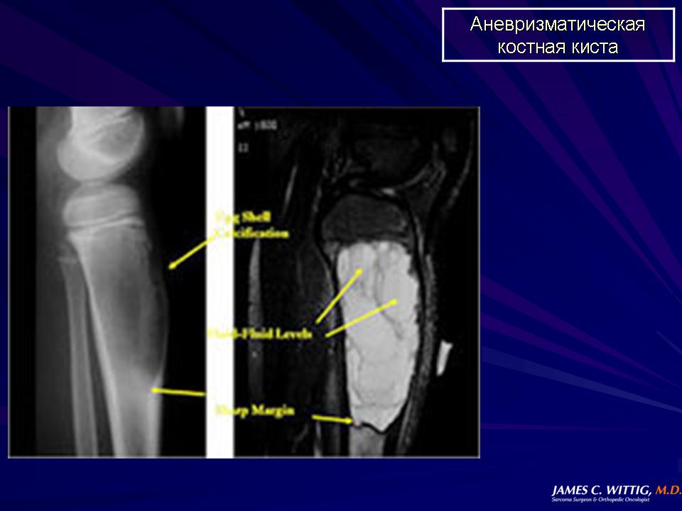 Киста костного мозга. Аневризмальная костная киста кт картина. Аневризматическая костная киста большеберцовой кости рентген. Солитарная киста бедренной кости.