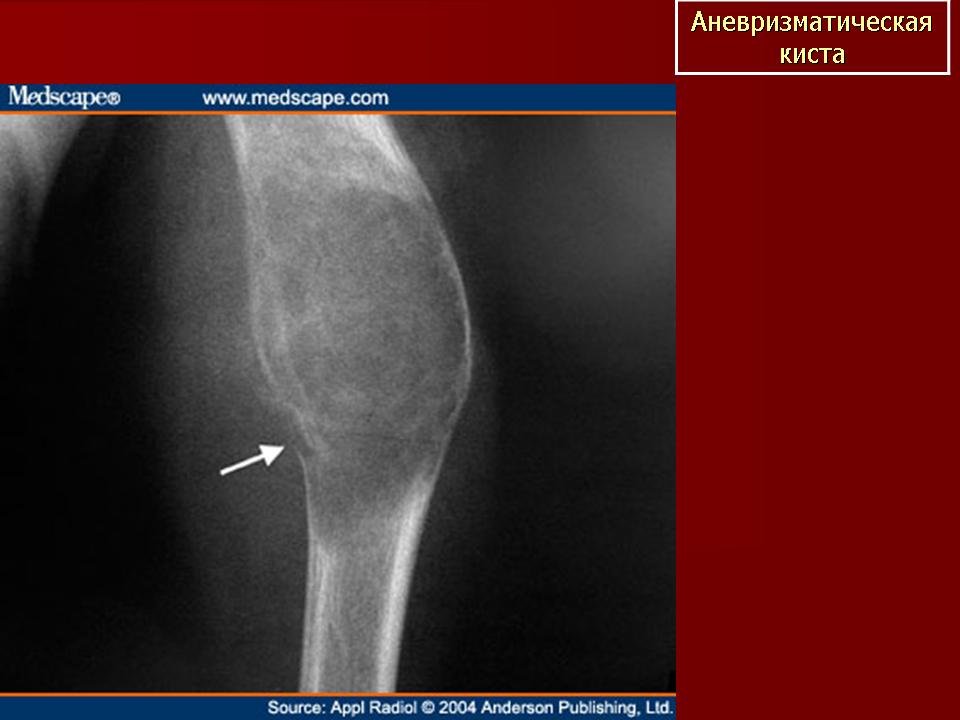 Киста кости. Аневризматическая костная киста мрт. Аневризматическая костная киста рентген. Солитарная костная киста плечевой кости. Аневризматическая киста плечевой кости кт.