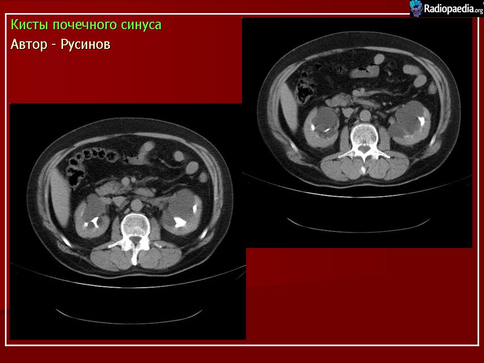 Киста левой почки. Синусные кисты почек на кт. Парапельвикальная киста почки кт. Перипельвикальные кисты почек на кт. Парапельвикальные кисты почек на кт.