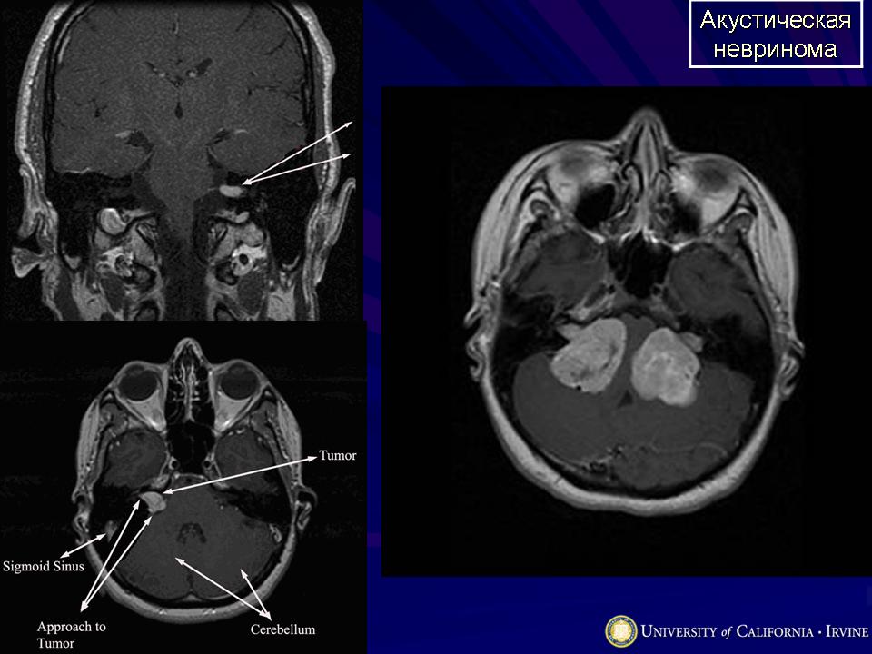 Невринома. Акустическая невринома мрт. Акустическая невринома кт.