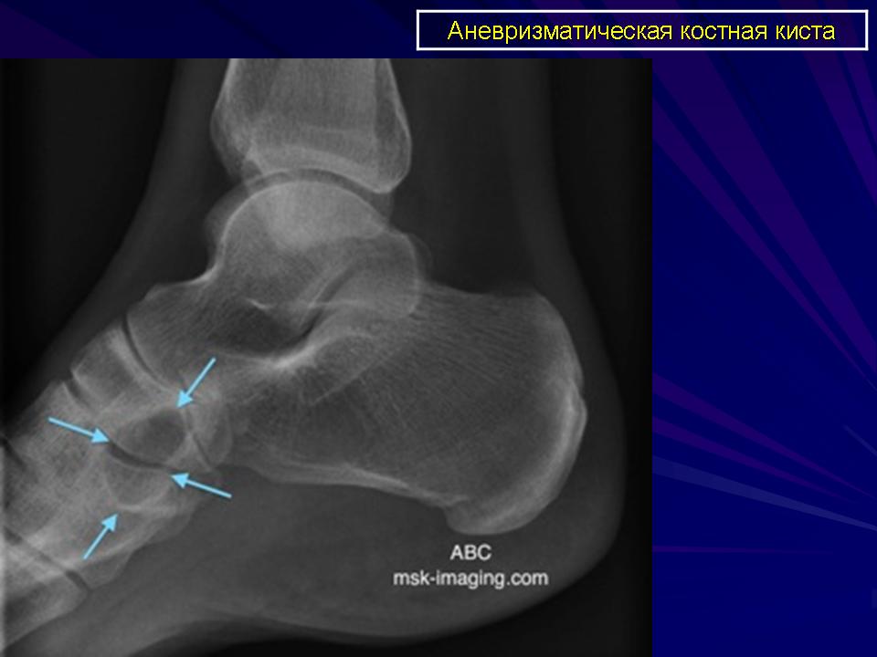 Киста пяточной кости