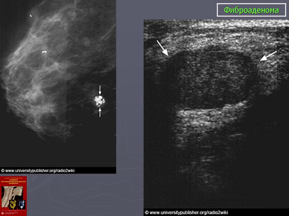 Что такое фиброаденома. Фиброаденома доброкачественная опухоль молочной железы УЗИ. Киста молочной железы и фиброаденома это. Фиброаденоматоз молочной железы на УЗИ. Фиброаденома мол жел УЗИ.