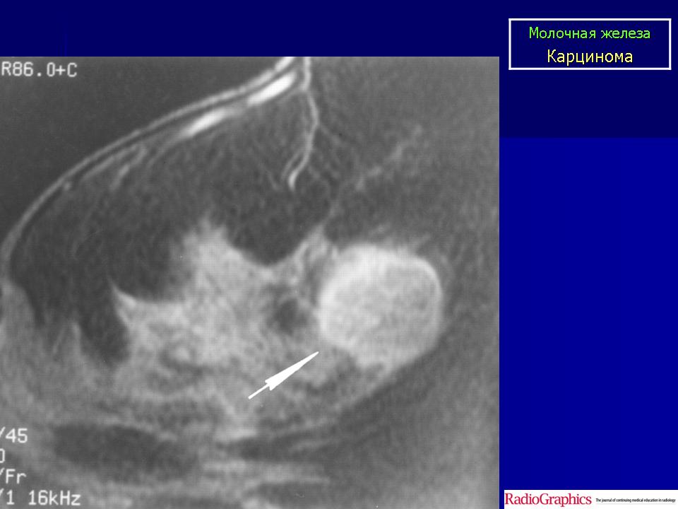 Рак груди1 стадии как распознать фото. Остеосаркома молочной железы. Серома молочной железы. Саркома молочной железы на УЗИ. Саркома молочной железы стадии.