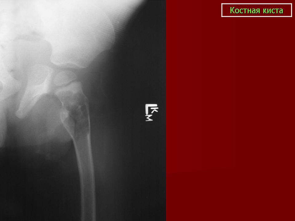 Костная киста. Солитарная костная киста рентген. Посттравматическая костная киста. Солитарная костная киста плечевой кости кт.