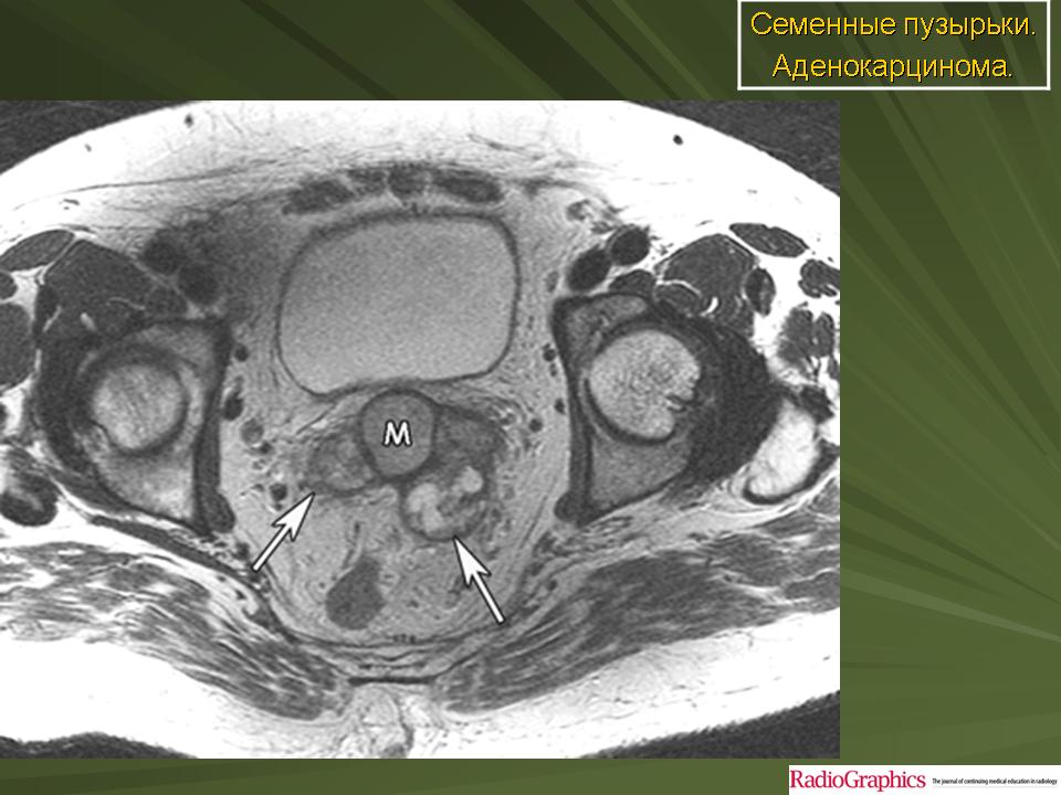 Мр признаки предстательной железы. Киста семенного пузырька мрт. Киста предстательной железы на кт. Тератома малого таза мрт. Амилоидоз семенных пузырьков мрт.