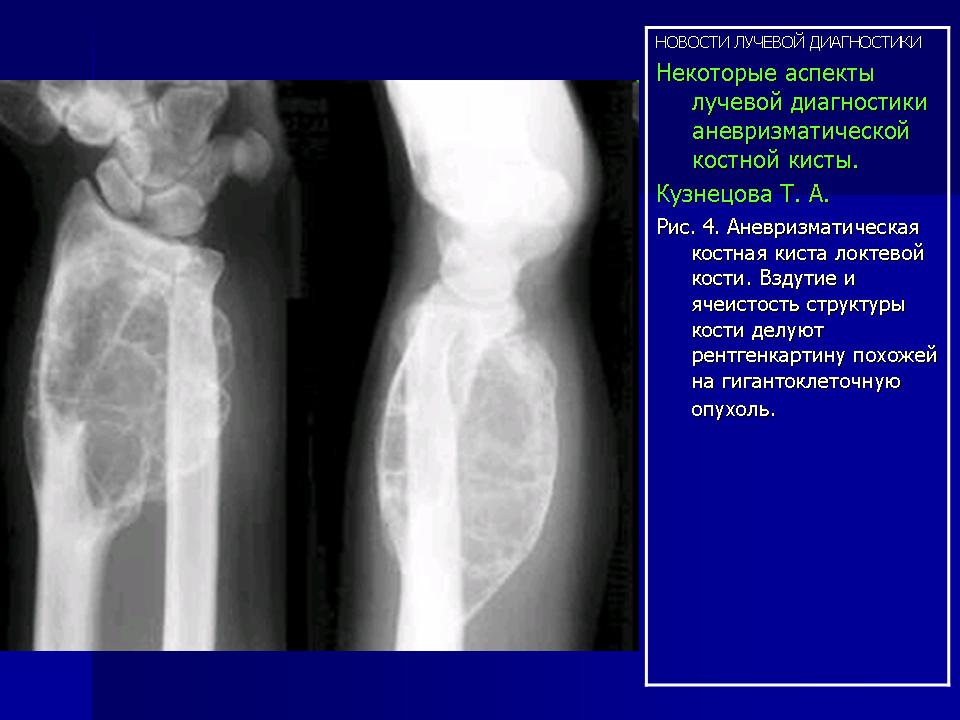 Киста бедренной. Аневризматическая костная киста рентген. Аневризмальная костная киста бедренной кости кт. Аневризматическая костная киста пястной кости. Аневризмальная костная киста бедренной кости мрт.