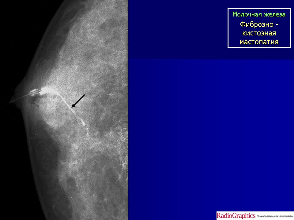 Фиброзно кистозная мастопатия молочных желез что это