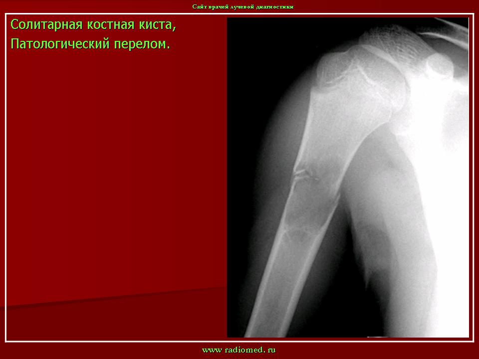 Костная киста. Костная киста плечевой кости. Солитарная костная киста. Костная киста плечевой кости кт. Солитарная костная киста плечевой кости.