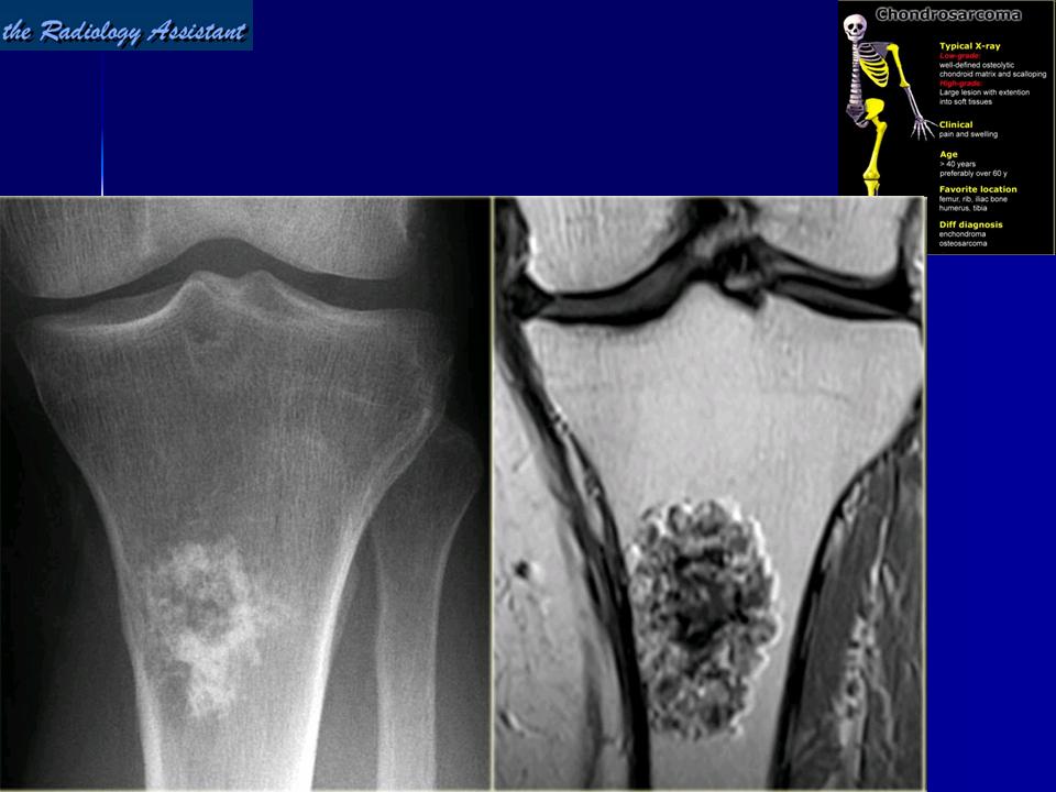 Симптомы рака костей. Энхондрома и хондросаркома. Хондросаркома рентген. Хондросаркома бедренной кости кт. Саркома большеберцовой кости мрт.
