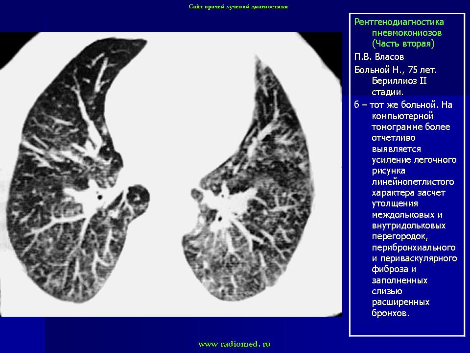 Пневмокониоз. Пневмокониоз беридиоз. Узловой пневмокониоз кт. Пневмокониоз легких бериллиоз. Бериллиоз рентген легких.