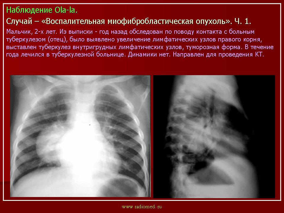 Опухоль средостения. Доброкачественная опухоль средостения рентген. Злокачественные новообразования средостения.