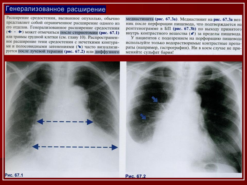 Расширение левой. Расширение тени средостения на рентгене.